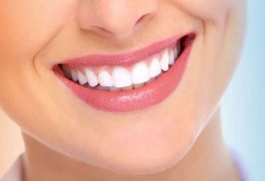 Traitement Hollywood smile